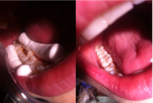 Лечение зубов - стоматологическая терапия