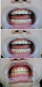 Эстетическая стоматология - художественная реставрация зубов