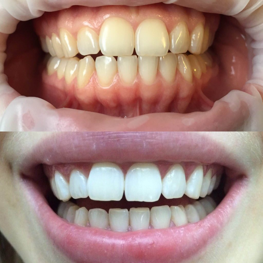 Профессиональная гигиена полости рта (профессиональная чистка зубов) и отбеливание зубов ZOOM.