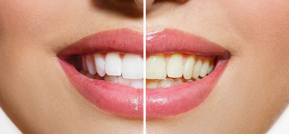 Профессиональная гигиена полости рта (профессиональная чистка зубов) и отбеливание зубов ZOOM.