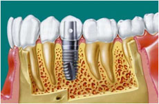 Подготовка к имплантации зубов