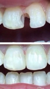 Лечение зубов - стоматологическая терапия